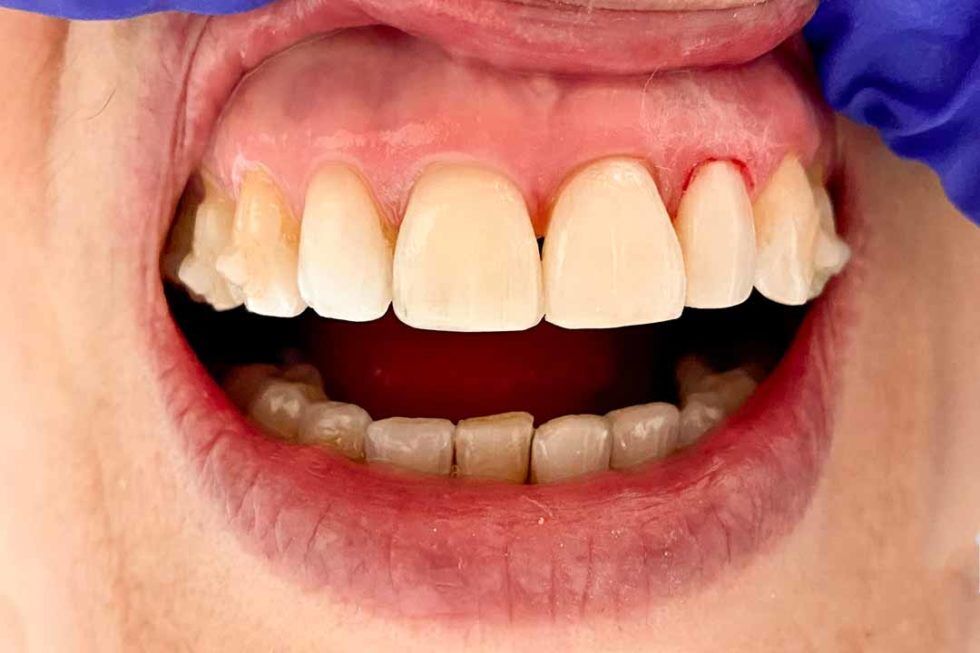 Dental Care in Ballston Spa, NY Billington Family Dentistry